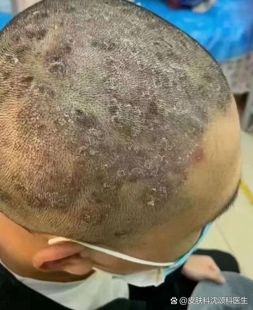 头癣是什么症状