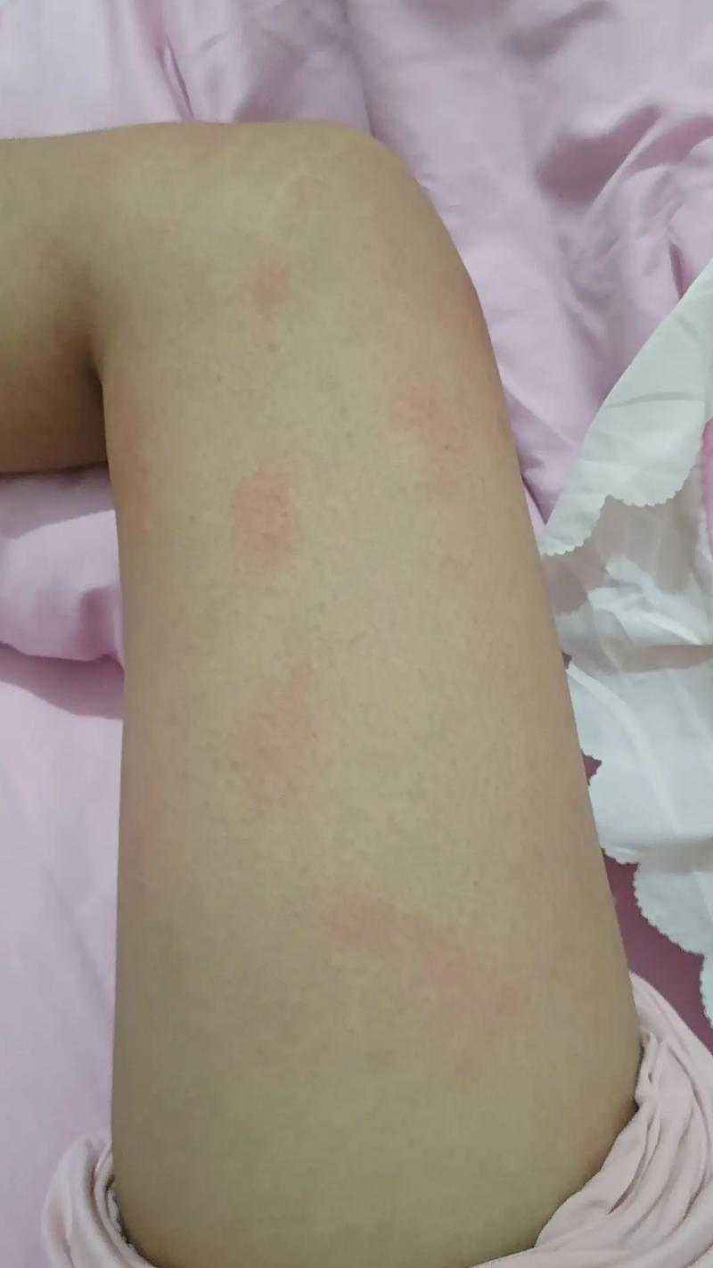 全身过敏是什么原因