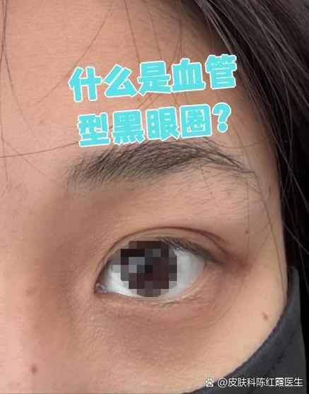 黑眼圈长什么样