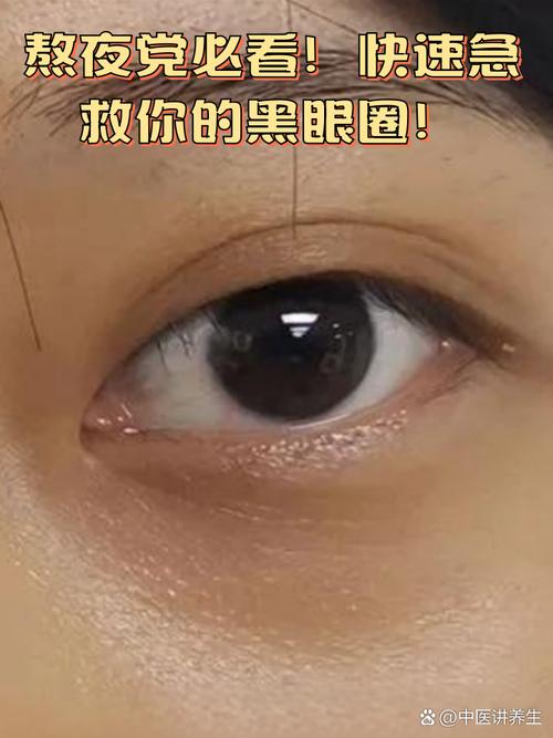 黑眼圈长什么样