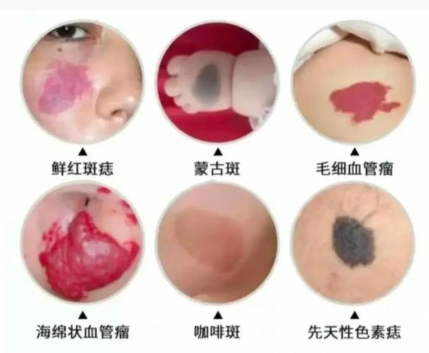 宝宝为什么有胎记