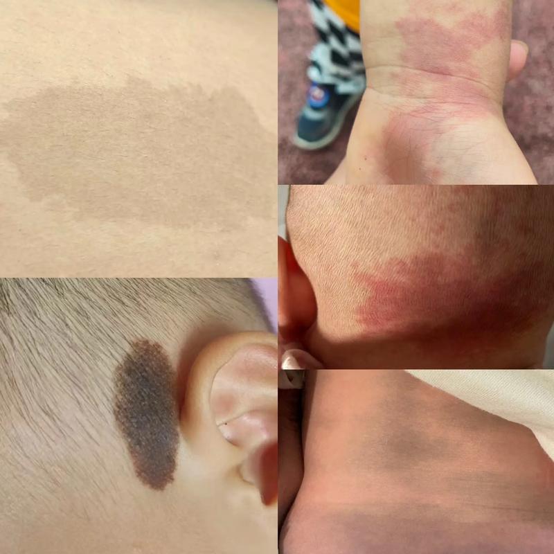 宝宝为什么有胎记