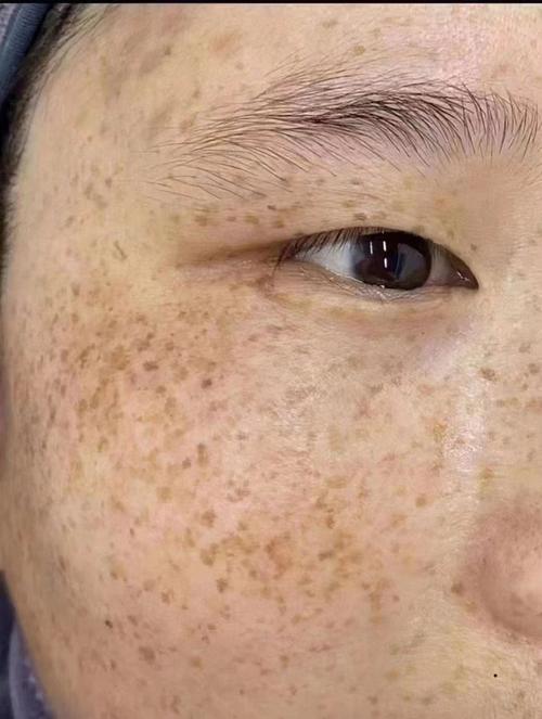 雀斑长什么样子