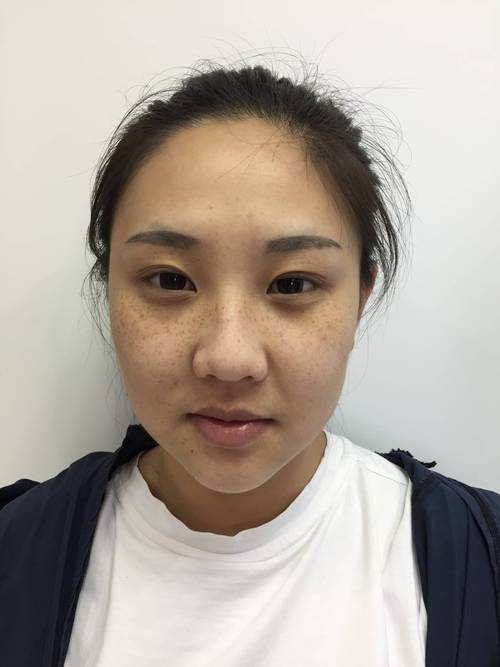 雀斑长什么样子