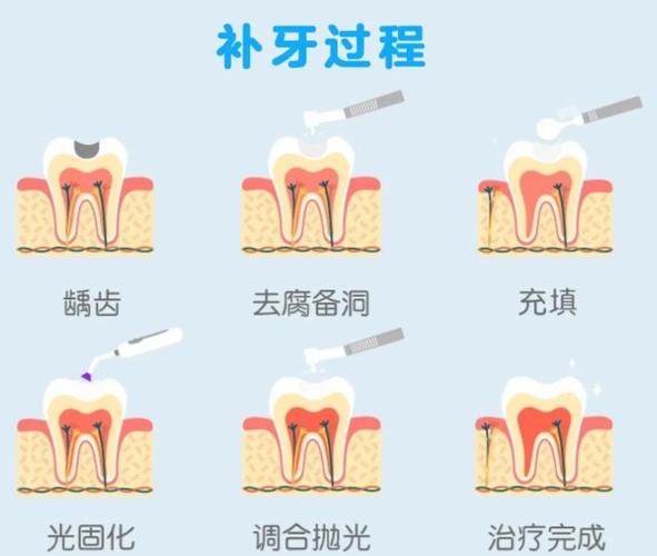 什么情况可以补牙