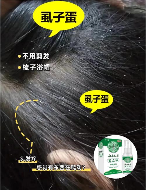 为什么会长头虱