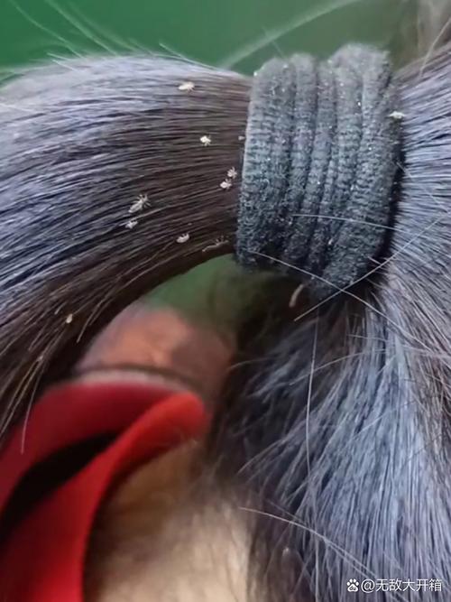 为什么会长头虱