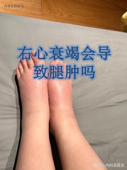 腿部肿是什么原因