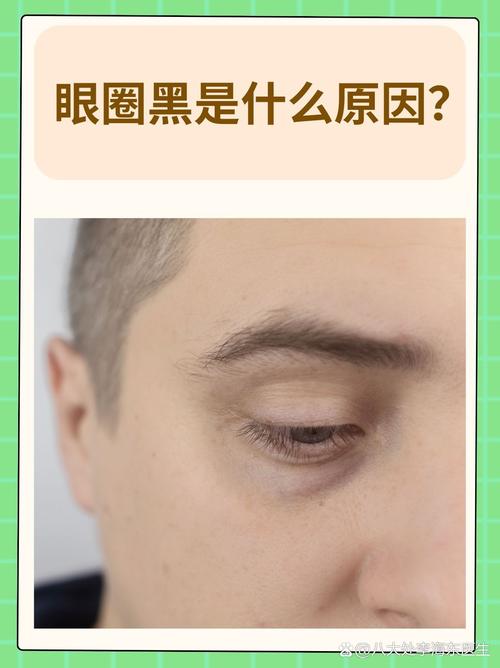 为什么会有黑眼圈呢
