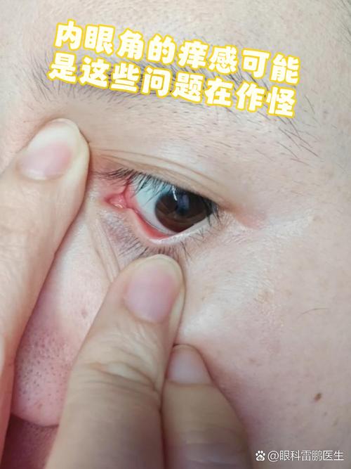 眼角肿痛是什么原因