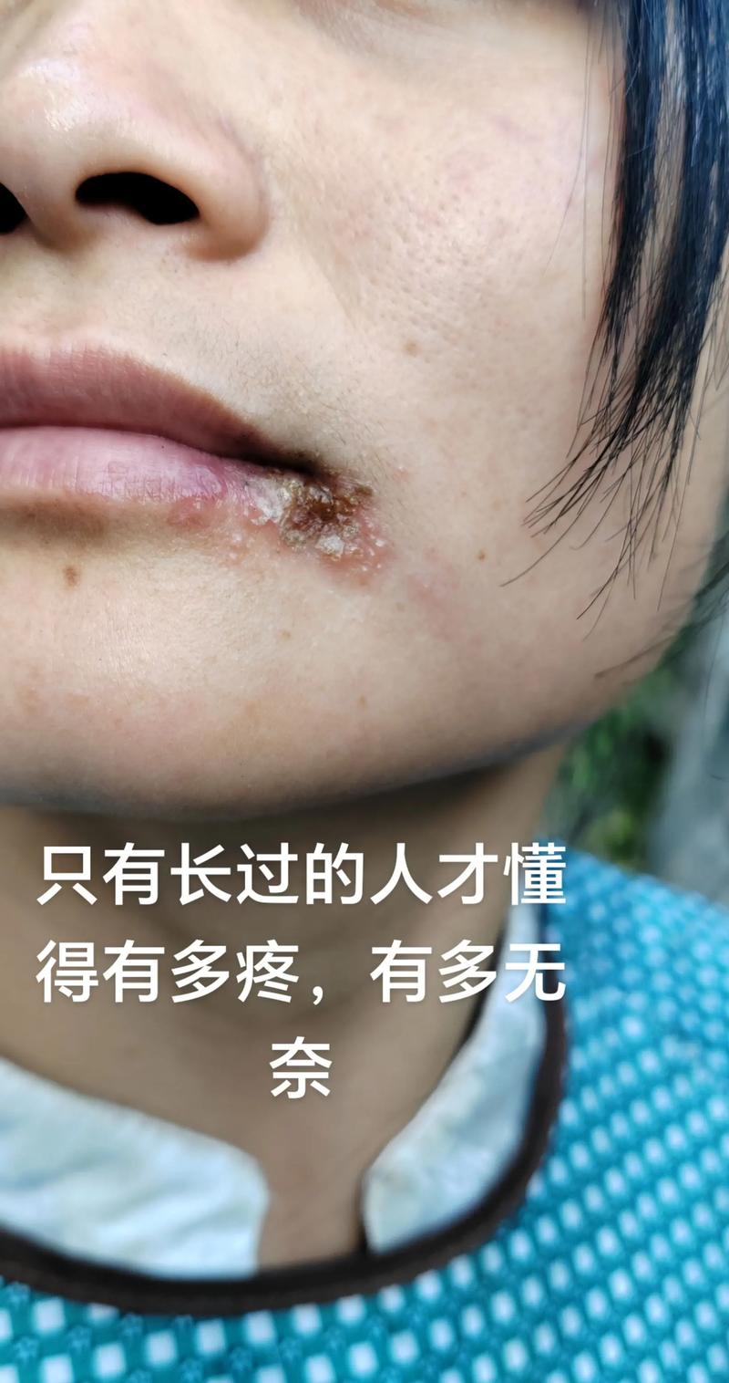 为什么嘴唇会长泡