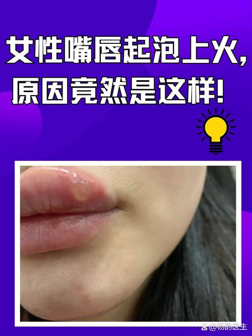 为什么嘴唇会长泡
