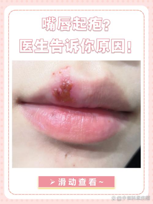 为什么嘴唇会长泡