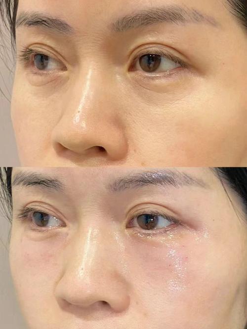 眼角的皱纹叫什么