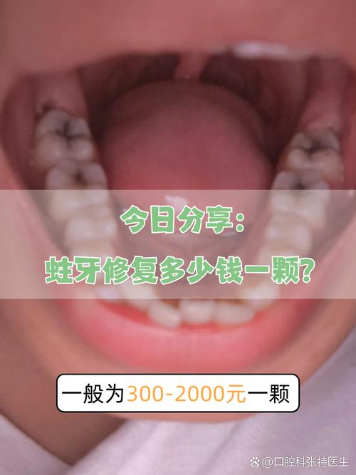 为什么补牙这么贵