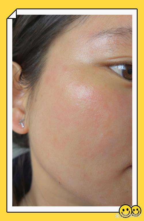 为什么脸老是过敏