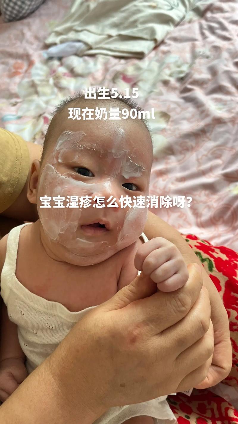 婴儿为什么起湿疹