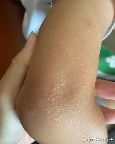 皮肤干燥缺乏什么