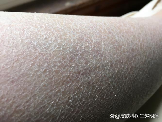 皮肤干燥缺乏什么