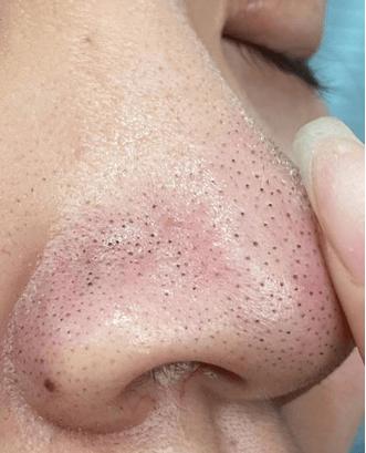 鼻子上的黑头是什么