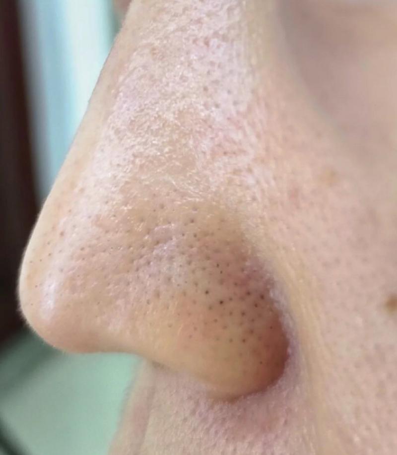 鼻子上的黑头是什么