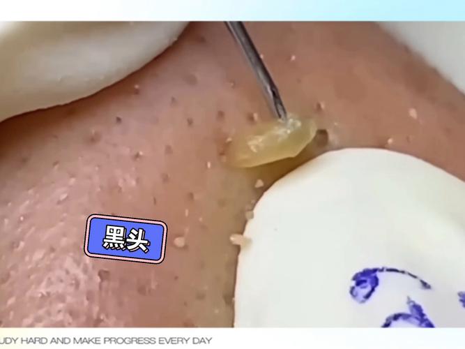 鼻子上的黑头是什么