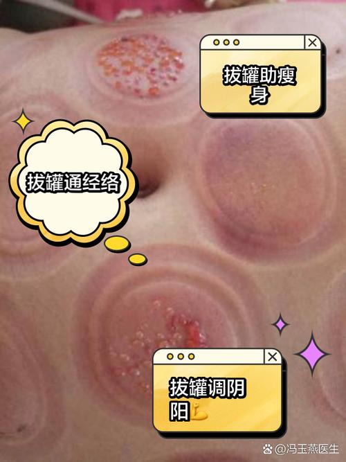 拔罐减肥为什么不能吃主食