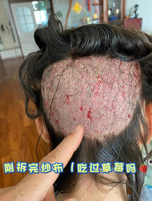 植发有什么危害