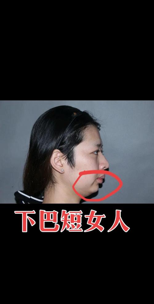 什么是短下巴