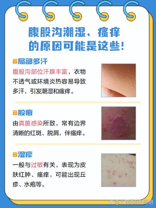 为什么会有股癣