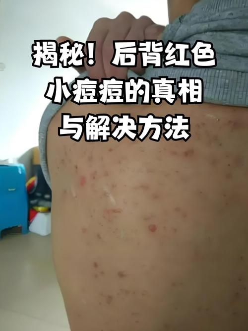 后背起痘痘什么原因