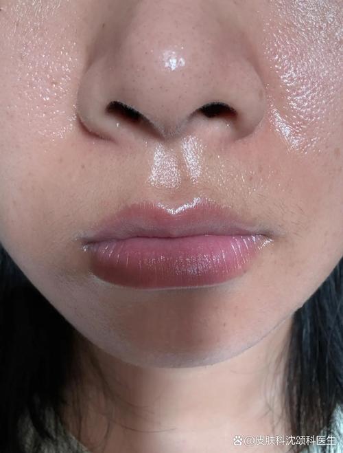 鼻子油是什么原因