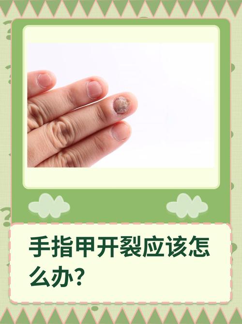 手指裂开是什么原因