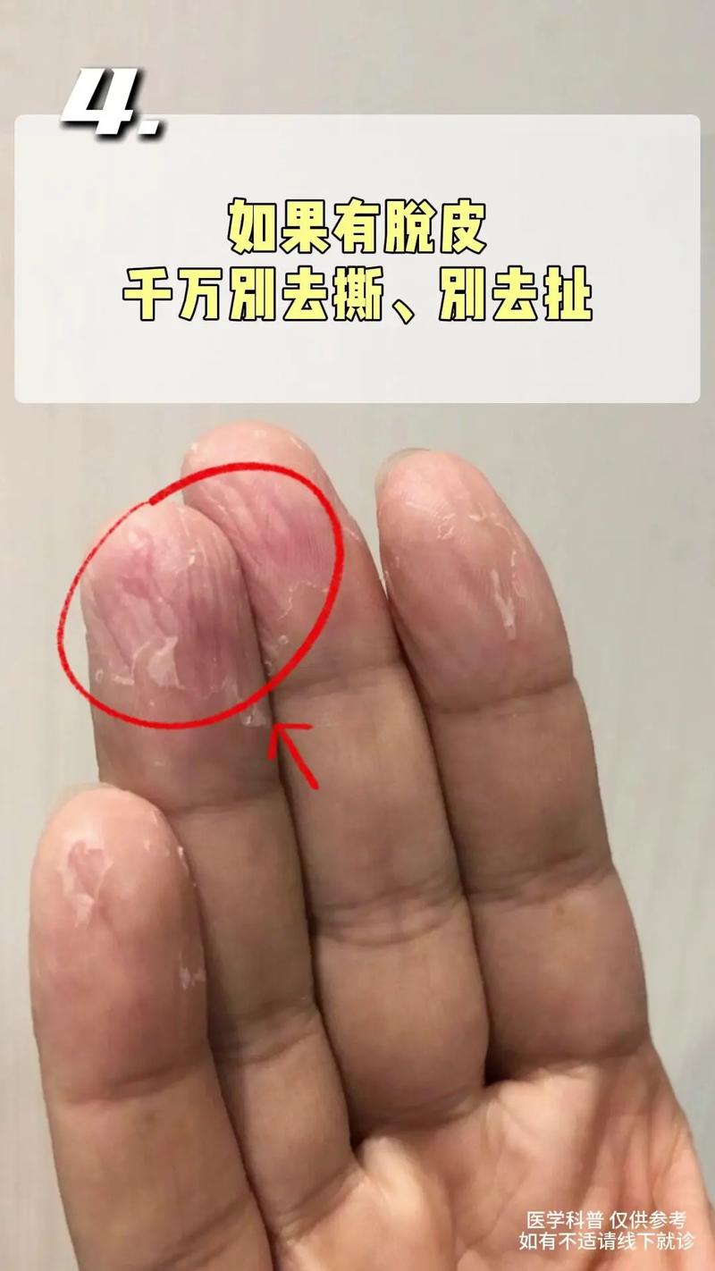 手指裂开是什么原因