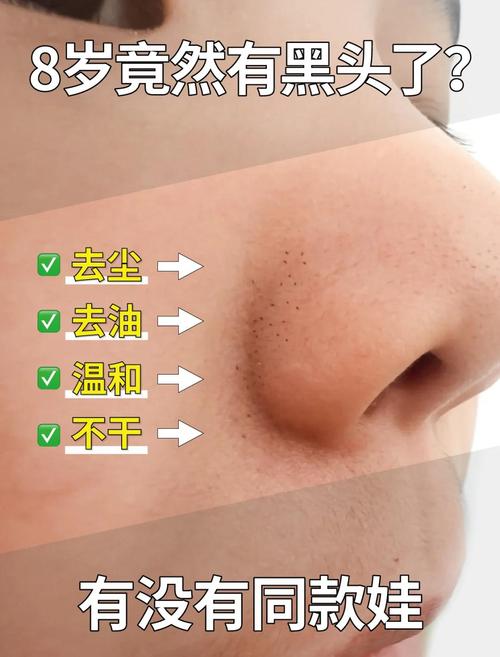 为什么会起黑头