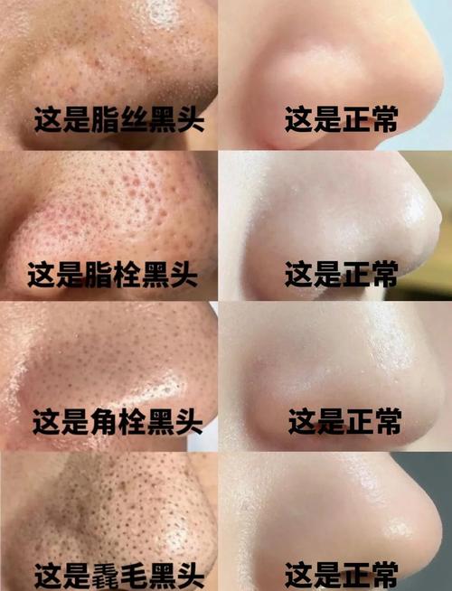 为什么会起黑头