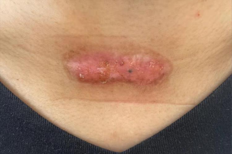 疤痕增生什么症状