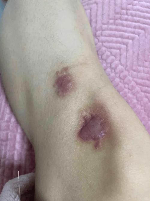 疤痕增生什么症状