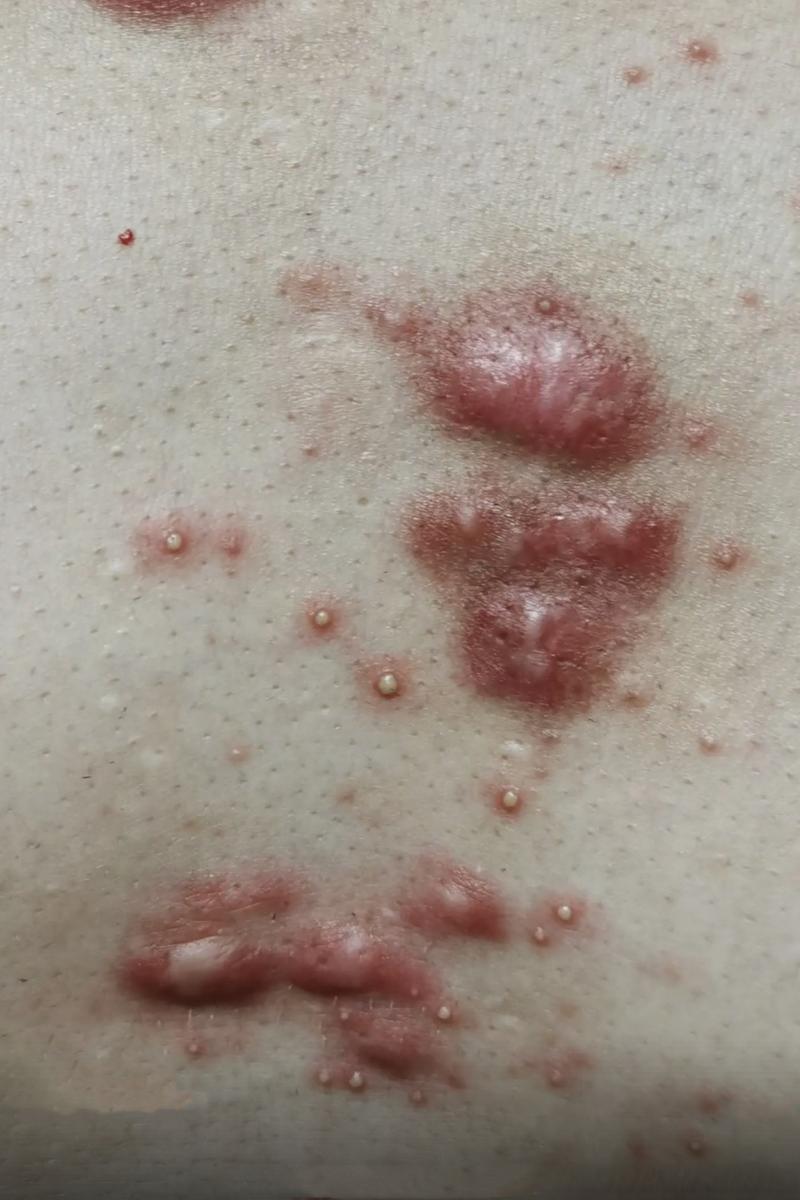 疤痕增生什么症状