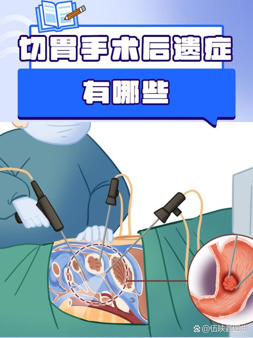 胃切除有什么影响