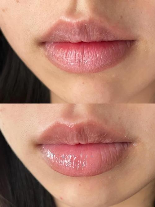 嘴唇起皮干裂什么原因