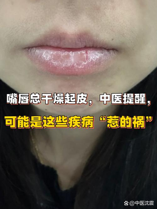 嘴唇起皮干裂什么原因
