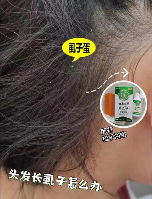为什么头发会长虱子