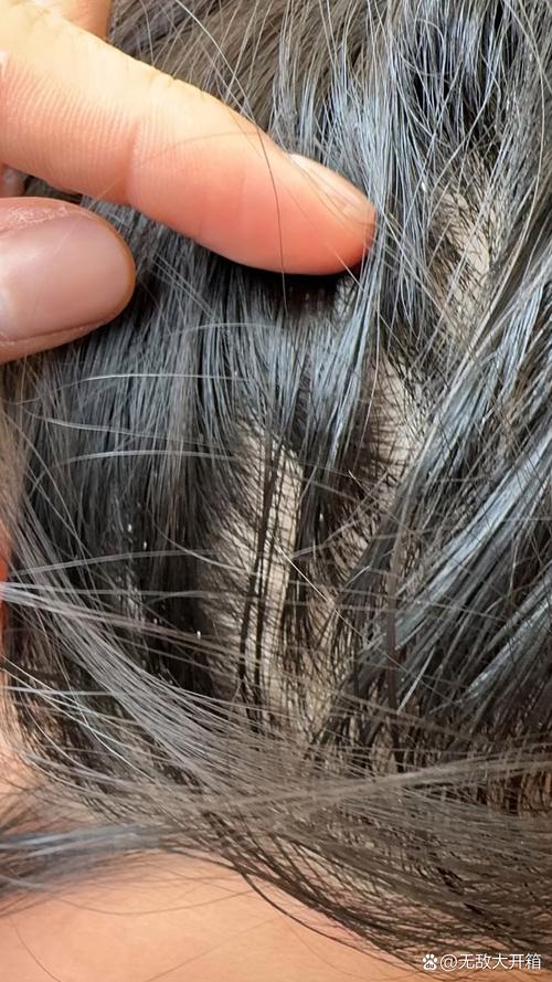 为什么头发会长虱子