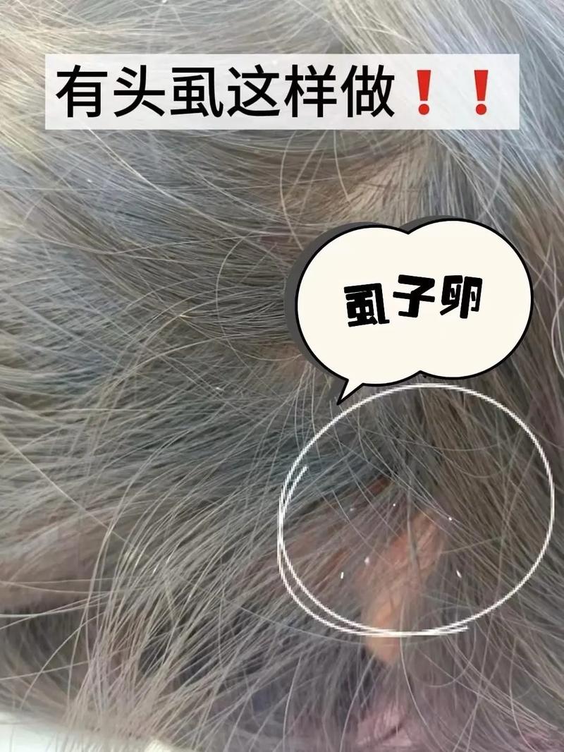 为什么头发会长虱子