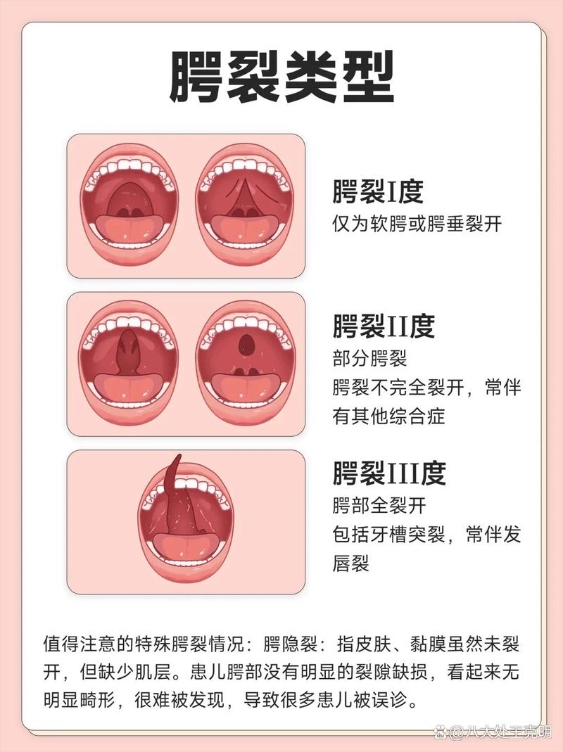 为什么会唇腭裂