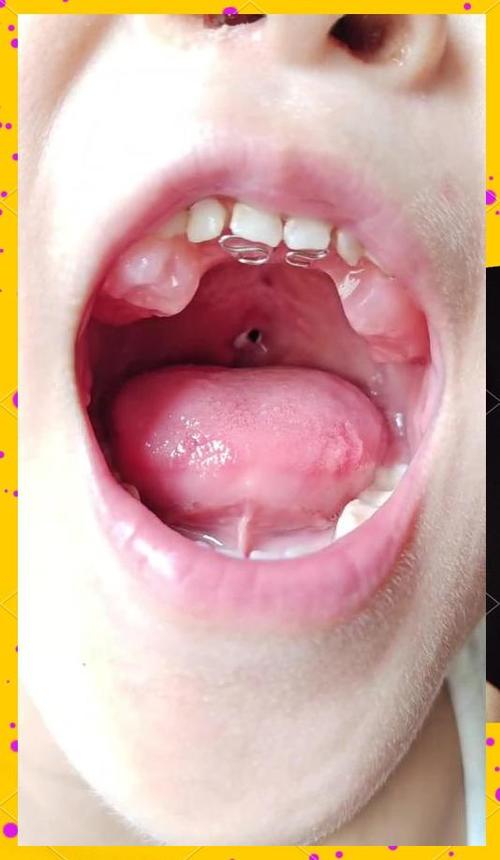 为什么会唇腭裂