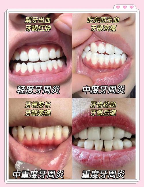 牙周炎什么症状