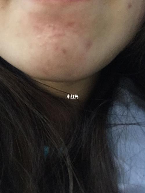 下巴起痘吃什么药