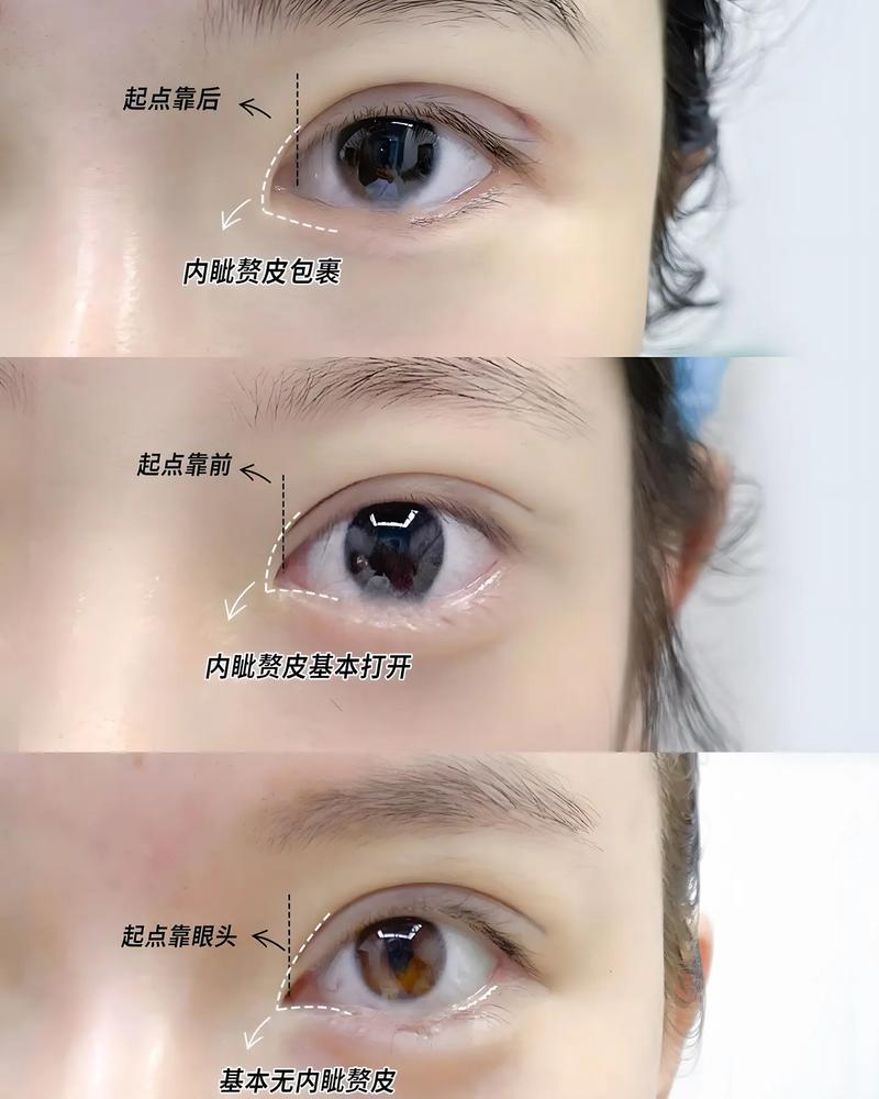 开眼角是什么意思